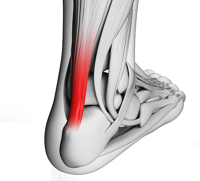 3d Darstellung des Fußes mit farblicher Hervorhebung der Achillessehne